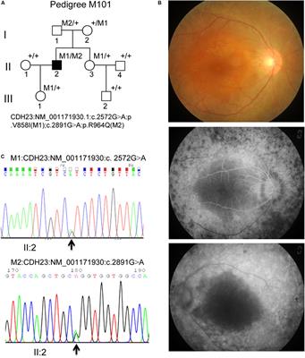 Targeted Next-Generation Sequencing Identified Novel Compound Heterozygous Variants in the CDH23 Gene Causing Usher Syndrome Type ID in a Chinese Patient